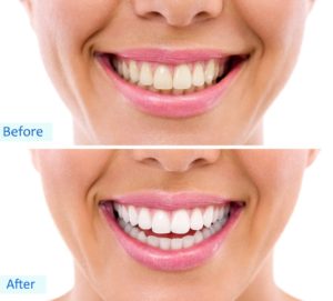 Before and After Teeth Whitening Photo