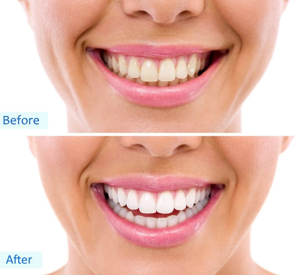 Before and After Teeth Whitening Photo