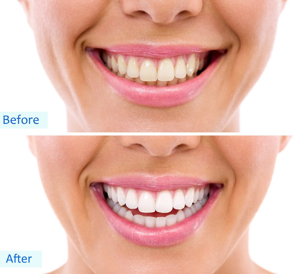 Should you brush your deals teeth after whitening strips