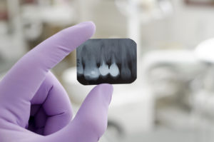 purple gloves root canal xray