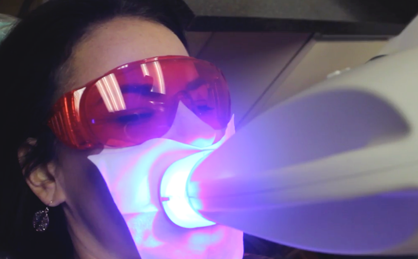 Teeth Whitening Systems
