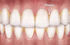 Describing what plaque looks like in a picture of teeth