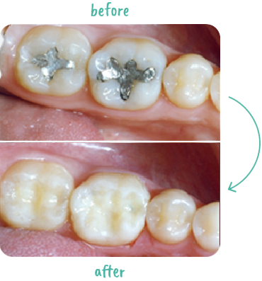 What do fillings clearance look like