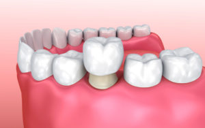 dental crown