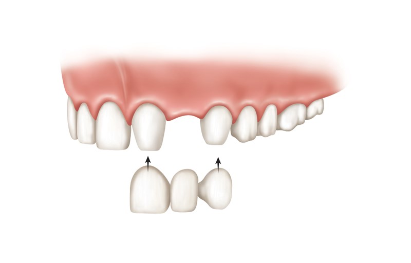 how-long-do-dental-bridges-last-lane-associates