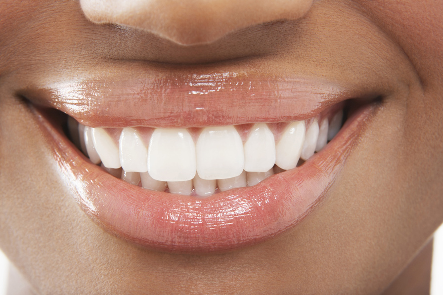 Teeth Whitening