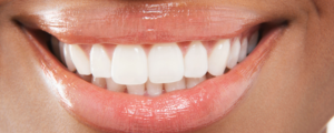 Closeup of Teeth Whitening