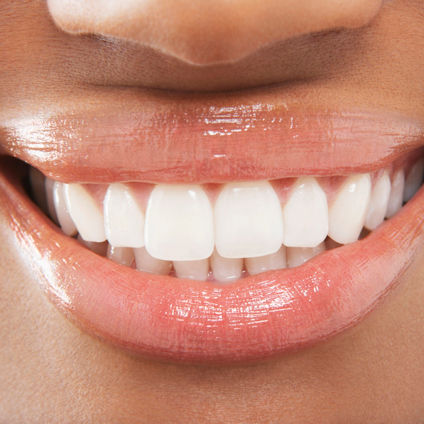 front-teeth-crowns-before-and-after