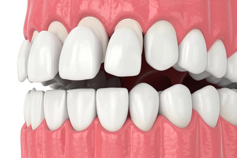 Composite Veneers Common Questions Answered Lane & Associates