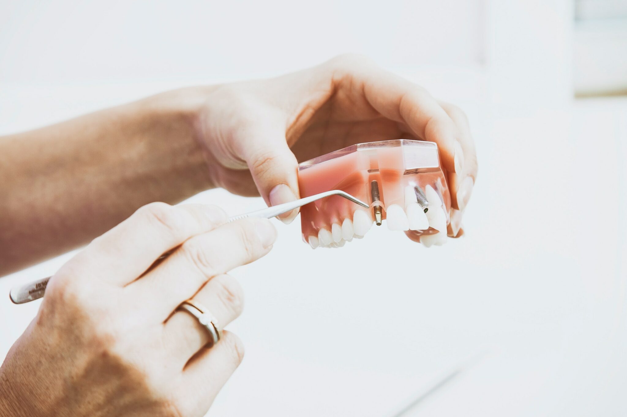 What is a Dental Abutment Tooth Lane & Associates