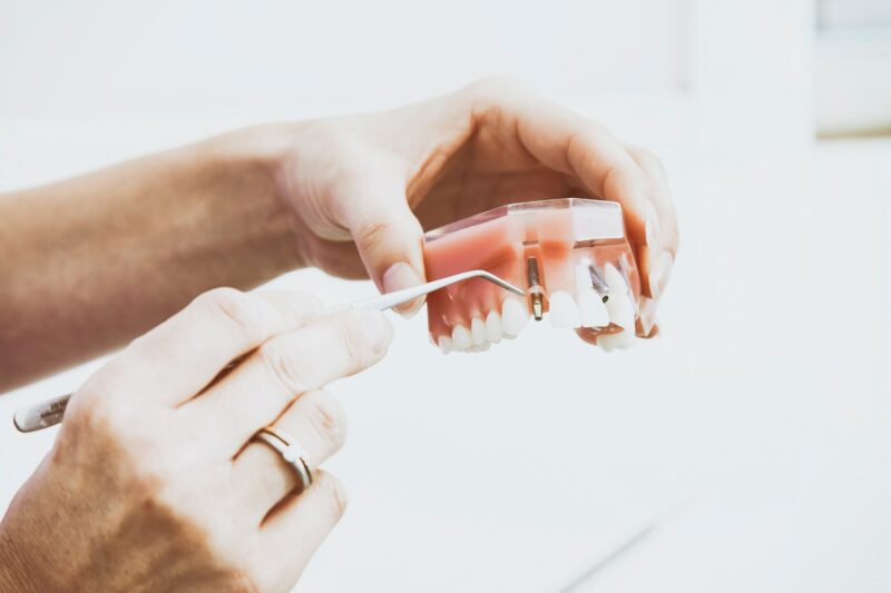 What is a Dental Abutment Tooth Lane & Associates