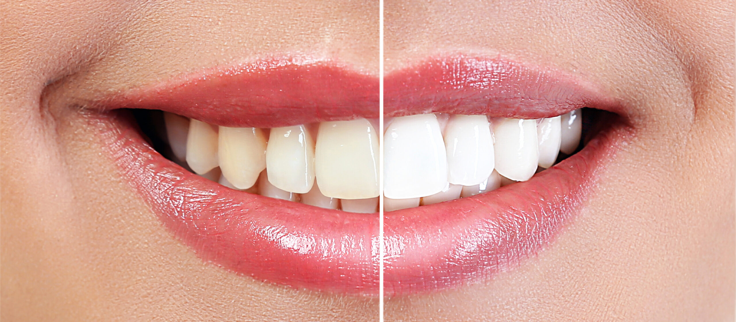 Picture of Teeth Whitening before and after