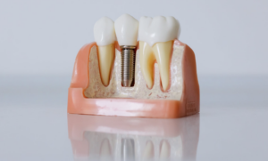 dental implant how it works