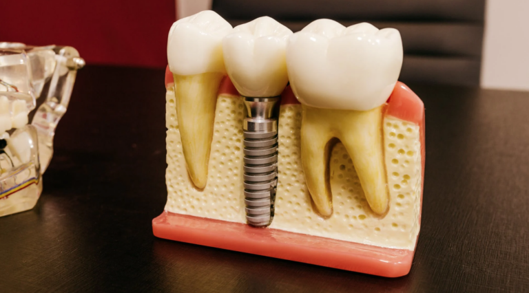 can-a-dental-implant-become-loose-lane-associates