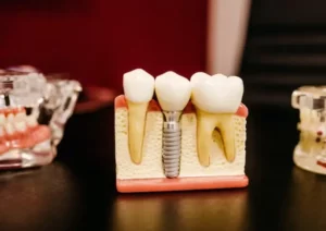 Dental Implants