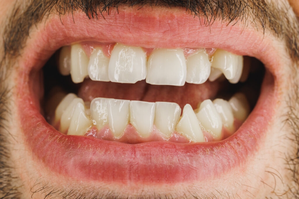 Can Your Teeth Bruise?