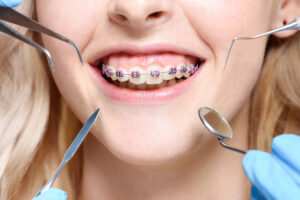 Closeup shot of dentist tools in front of smiling mouth with braces.