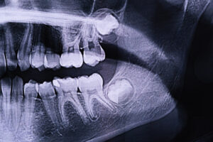 Panoramic X-ray of the jaw. X-ray of the teeth of a 12-year-old girl.